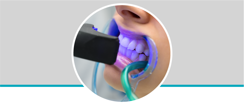 Blanqueamiento dental